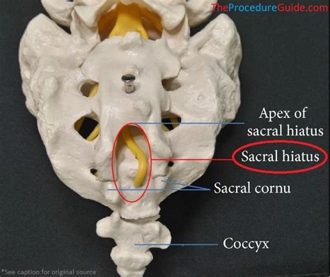 Fluoroscopic Guided Caudal Epidural Steroid Injection – Technique and ...