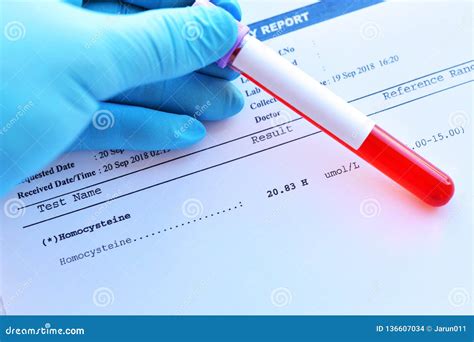 Laboratory Result of Homocysteine Test Stock Photo - Image of analyzing, amino: 136607034