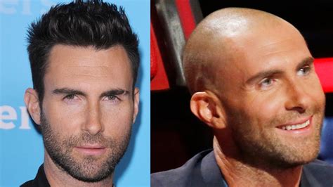 Top 10 Celebrity Hair Transplants | BabbleTop