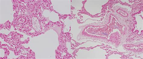 Amniotic fluid embolism: Pathophysiology and new strategies for management - Kanayama - 2014 ...