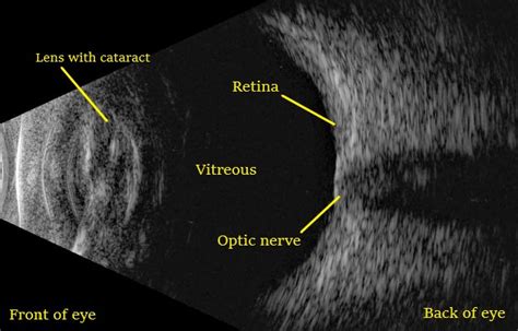 Bright Scan Ultrasound (B Scan)