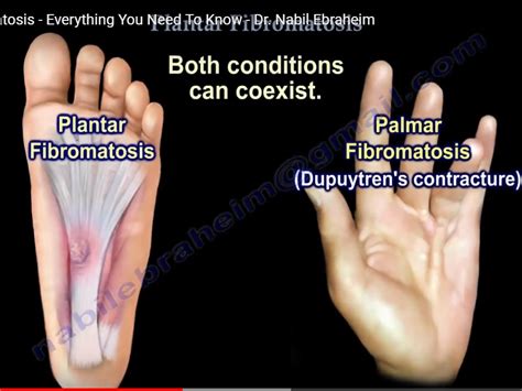 Plantar Fibromatosis — OrthopaedicPrinciples.com