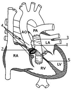 23 B-T Shunt ideas | stenosis, pulmonary, arteries