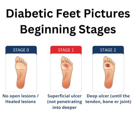 Diabetic Foot Ulcers And Their Recurrence NEJM, 55% OFF