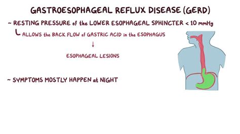 Schatzki Ring: What Is It, Causes, Treatment, and More | Osmosis