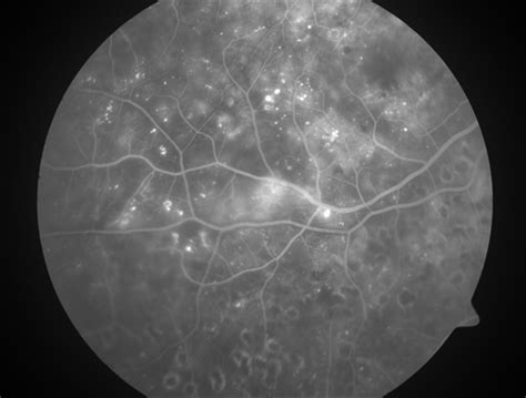 Diabetic Macular Edema - Leaking Microaneurysms - Retina Image Bank