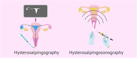 Types of hysterosalpingography