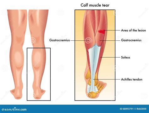 Calf Muscle Tear Stock Vector - Image: 68893791