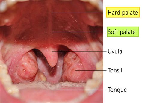 Soft palate anatomy, soft palate function and soft palate cancer