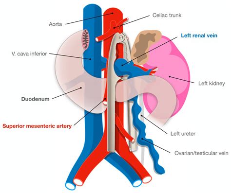 Nutcracker Syndrome Causes