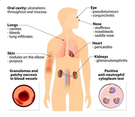 Granulomatosis with Polyangiitis