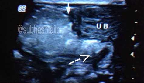 SONO DIGEST: ULTRASOUND IN NEONATAL HIRSCHSPRUNG DISEASE