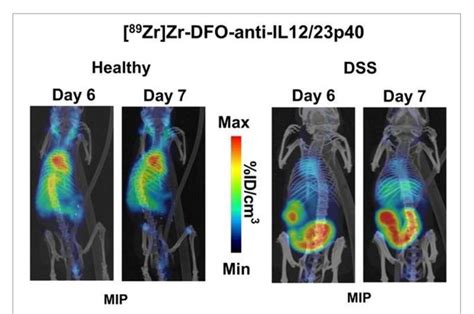 Novel PET radiotracer facilitates early, noninvasive detection of inflammatory bowel disease