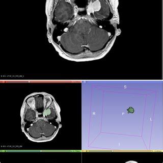 Meningioma of the skull base (above); semi-automatic segmentation with ...