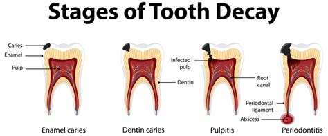 5 Stages Of An Abscessed Tooth & What To Do