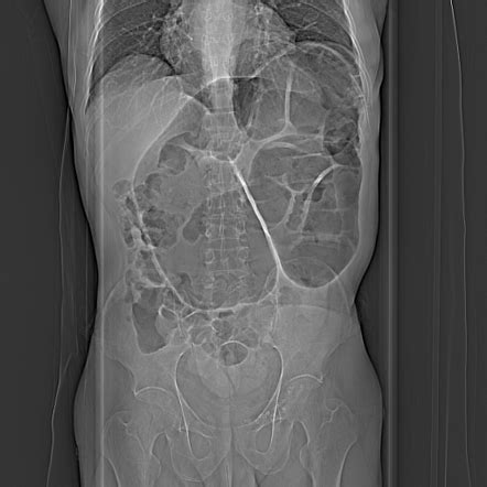 Sigmoid volvulus | Radiology Reference Article | Radiopaedia.org