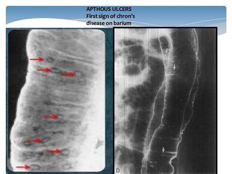 INFLAMMATORY BOWEL DISEASE IMAGING(RADIOLOGY)