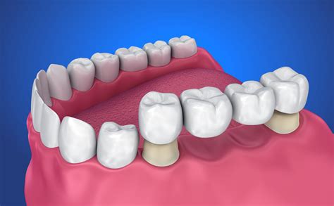 What Do You Know About Dental Bridges, And Who Needs Them?