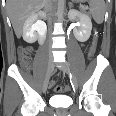 Laparoscopic Robotic Pyeloplasty » Department of Urology » College of Medicine » University of ...