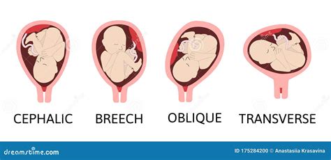 Verschillende Babyposities Tijdens De Zwangerschap. Doorsnede Schuine Strepen. Gekleurde ...