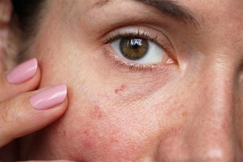 How Do I Treat and Prevent Spider Veins on My Face? - Zcosmetic Health