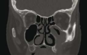 CT scan shows an opacification of left maxillary sinus with evidence of ...