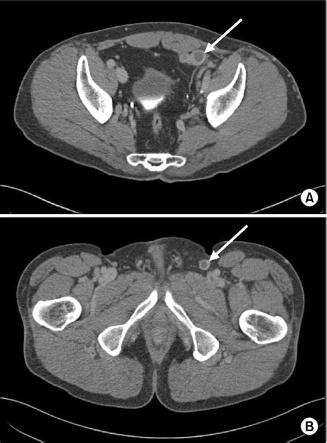 Deep vein thrombosis in the left external iliac vein (arrow in A),... | Download Scientific Diagram