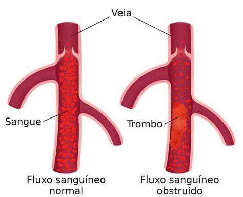 Trombose - causas, sintomas e tratamentos - Doenças - InfoEscola