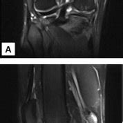 31year old male patient complaining of knee pain 2years following ACL... | Download Scientific ...
