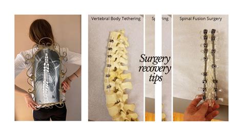 Scoliosis Surgery Recovery Tips! (VBT/ASC & Fusion) - YouTube