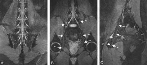 Lumbar Plexus Mri