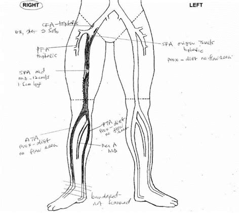 Remote Endarterectomy for an Occluded Superficial Femoral Artery (SFA) Stent ? a Hybrid ...