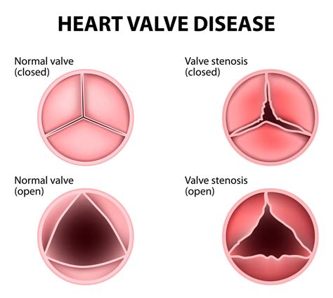 What Are Heart Valve Flaps? - Dr. Peter Mikhail