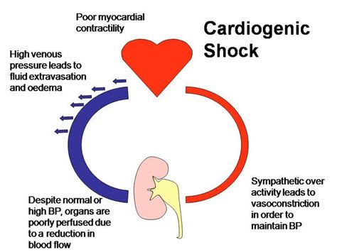 cardiogenic shock | Cardiogenic shock, Nurse quotes, Emergency nursing