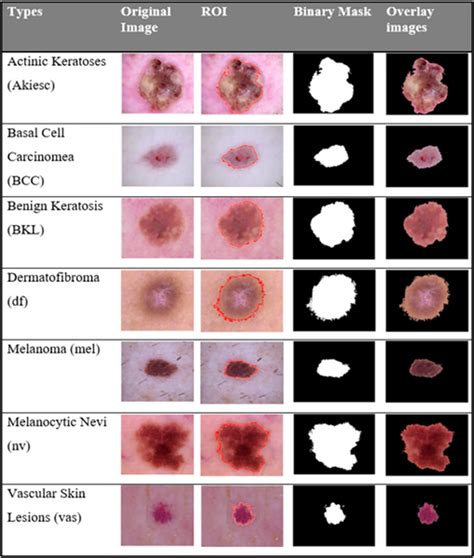 perle Overleve middag types of skin lesions spiller Milestone Tilintetgøre