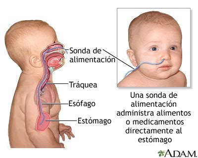 sonda nasogastrica alimentacion - Buscar con Google | Feeding tube ...