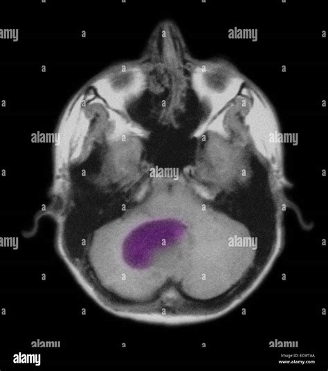 Pilocytic astrocytoma of the brain as seen on MRI scan Stock Photo - Alamy