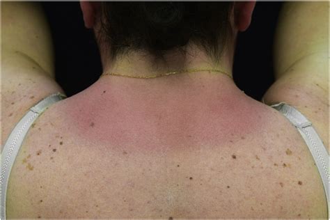 Erythematous rash located in photo-exposed areas: neck. | Download Scientific Diagram