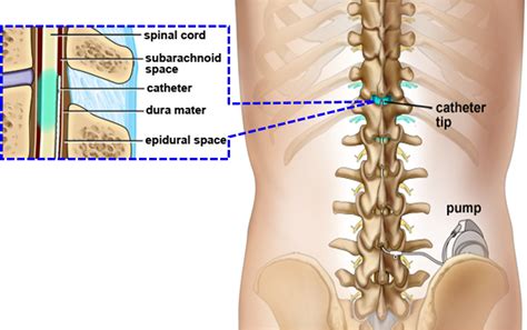 Severe Cancer Pain Treatment