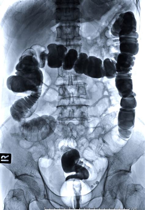 Computed Tomography of the Abdomen/Pelvis| Radiology Associates of ...