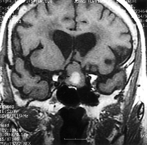 Pituitary Apoplexy - USMLE Strike