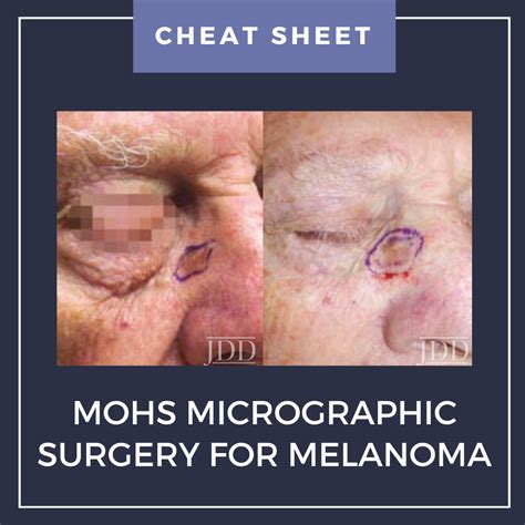 Mohs Micrographic Surgery for Melanoma (MMS-M) | Cheat Sheet - Next ...