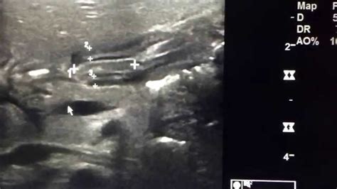 Pyloric Stenosis Ultrasound