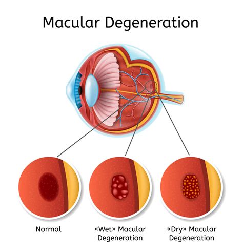 Wet Macular Degeneration | Wet AMD Cilnical Trial | FLEI