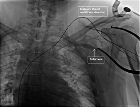 Axillary Vein Cephalic Vein