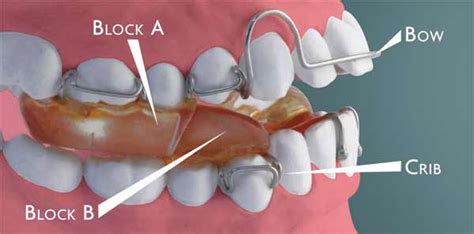 Twin Block Appliance - Align Orthodontics : Align Orthodontics