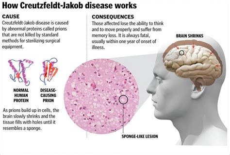 Researchers Find Infectious Prion Protein in Skin of CJD Patients – Global Health News Wire