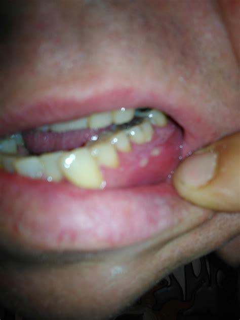 White Spots On Gums Painful Gums Spot Spots Hurts Cau - vrogue.co