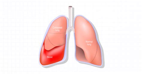 Hemothorax: Overview and Practice Questions (2023)