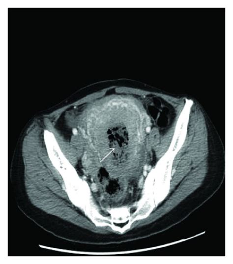 √ Uterus Endometriosis Ct Scan / Tumors Of The Uterine Corpus Clinical Gate : The best way to ...